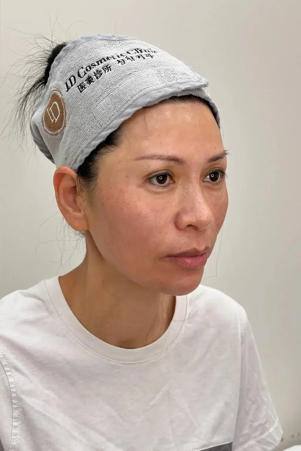 Hyperpigmentation After · Case 22 · Luowei Medical Aesthetics Clinic