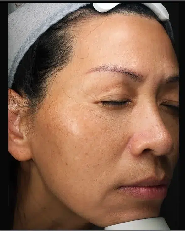 Pigmentation Before · Case 09 · Luowei Medical Aesthetics Clinic