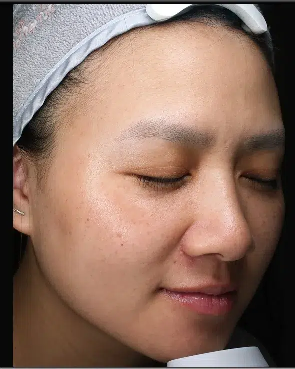 Treating Melasma — Before · Case 16 · Luowei Medical Aesthetics Clinic