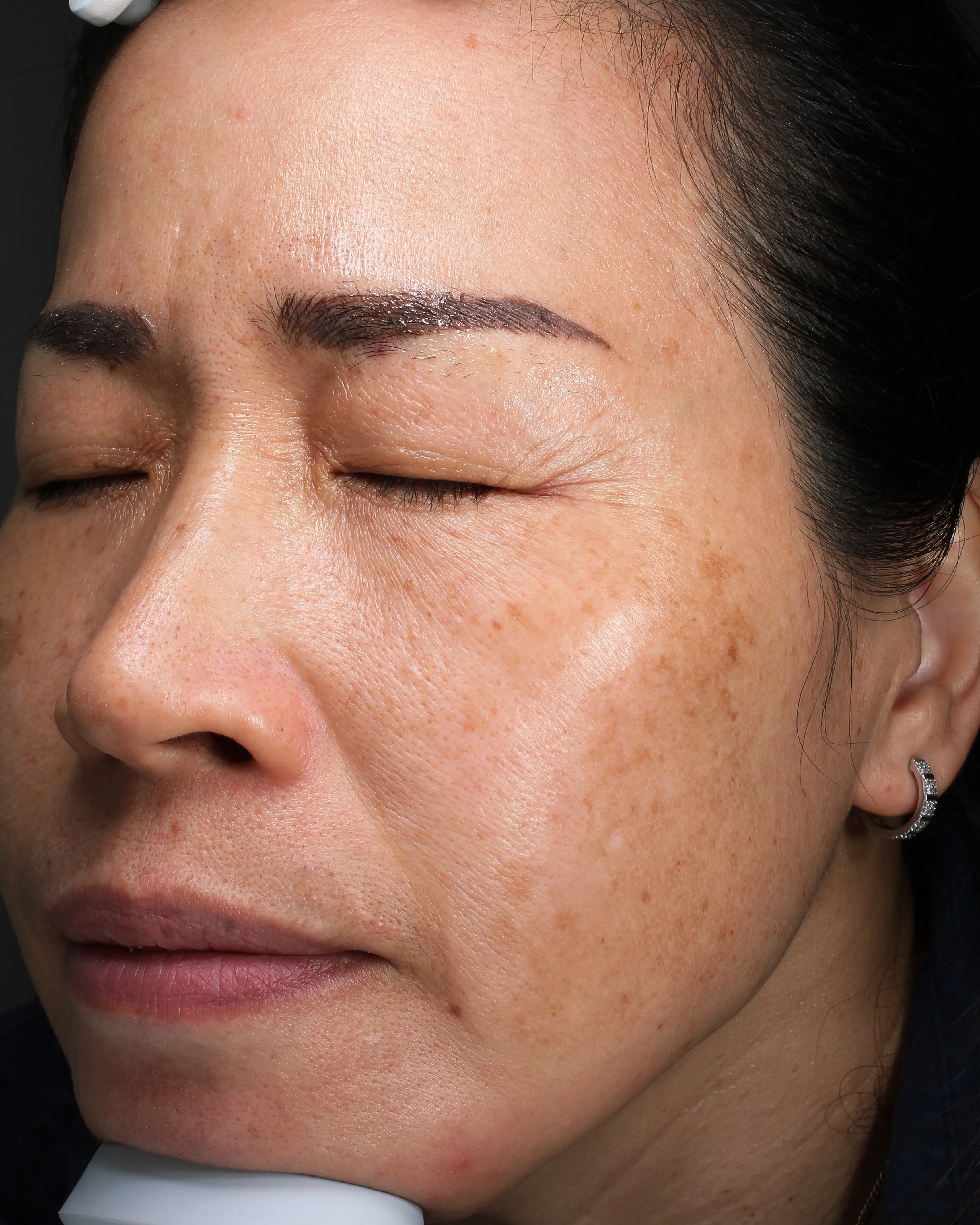 Melasma Treatment Before · Case 18 · Luowei Medical Aesthetics Clinic