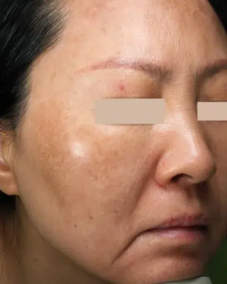 Hyperpigmentation Before · Case 18 · Luowei Medical Aesthetics Clinic