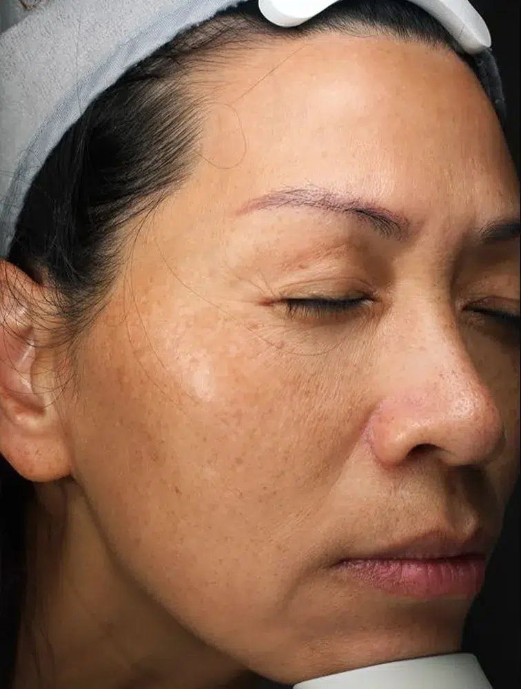 Pigmentation pre-treatment · Case 20 · Luowei Medical Aesthetics Clinic