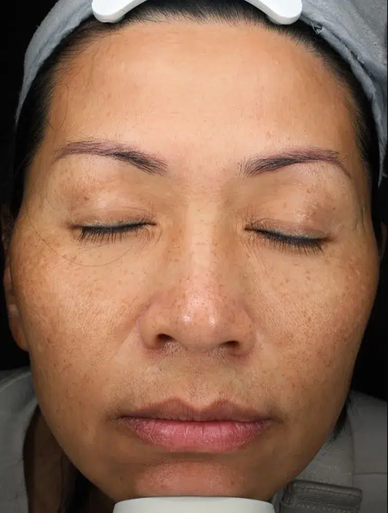 Melasma — Before Treatment · Case 41 · Luowei Medical Aesthetics Clinic