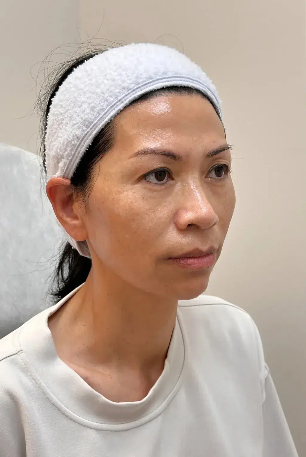 Hyperpigmentation Before · Case 22 · Luowei Medical Aesthetics Clinic