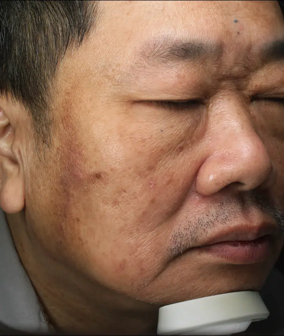 Post-Inflammatory Hyperpigmentation — Before Treatment · Case 01 · Luowei Medical Aesthetics Clinic