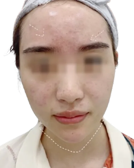 Luowei Facial Sculpturing · After · Case 01 · Luowei Medical Aesthetics Clinic
