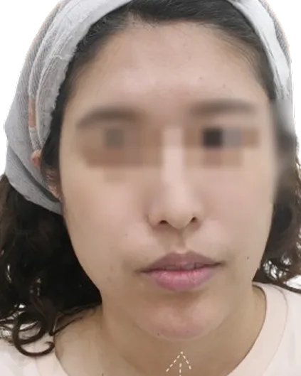 Chin Retrusion — After · Case 6 · Luowei Medical Aesthetics Clinic