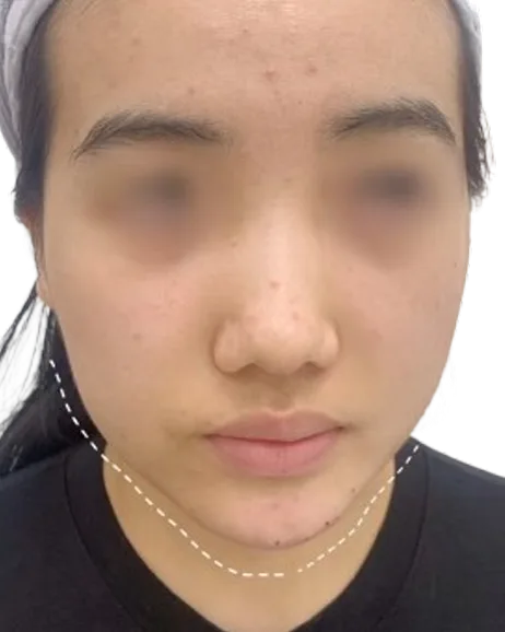 Chin recession — After Treatment · Case 8 · Luowei Medical Aesthetics Clinic