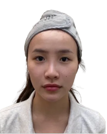 Recessed Chin — After · Case 10 · Luowei Medical Aesthetics Clinic