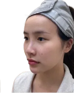 Luowei Facial Sculpturing · After · Case 06 · Luowei Medical Aesthetics Clinic