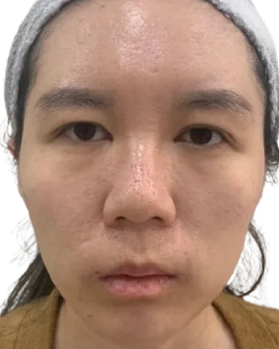 Chin recession — After Treatment · Case 13 · Luowei Medical Aesthetics Clinic