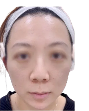 Recessed Chin — After · Case 15 · Luowei Medical Aesthetics Clinic