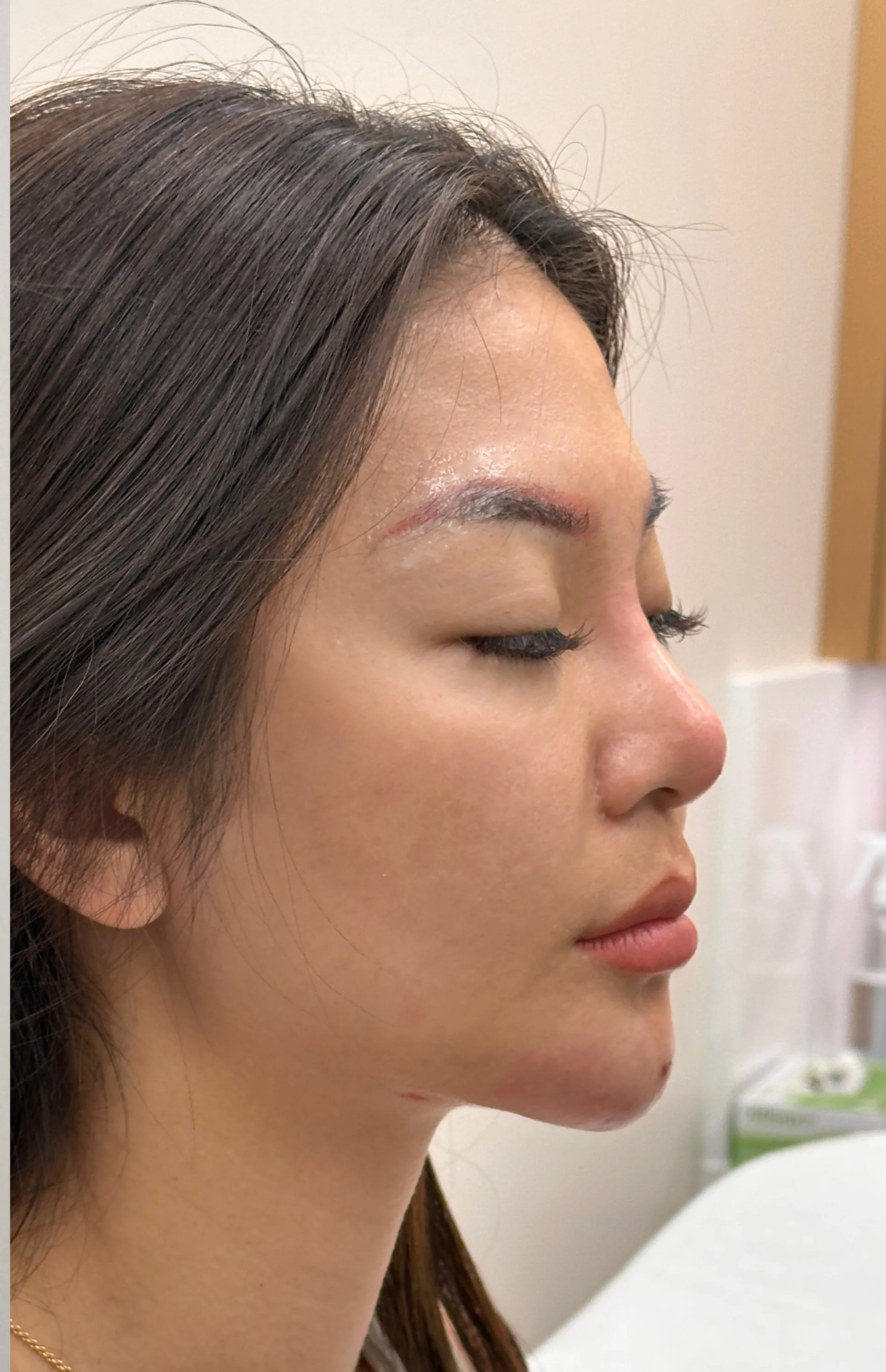 Chin recession — After Treatment · Case 19 · Luowei Medical Aesthetics Clinic