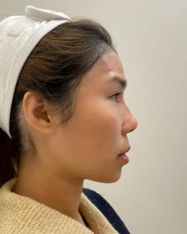 Chin Recession — After · Case 2 · Luowei Medical Aesthetics Clinic