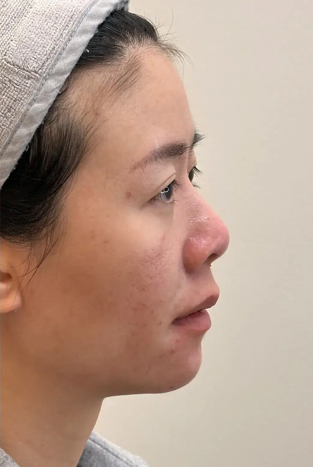 Recessed chin · After · Case 40 · Luowei Medical Aesthetics Clinic
