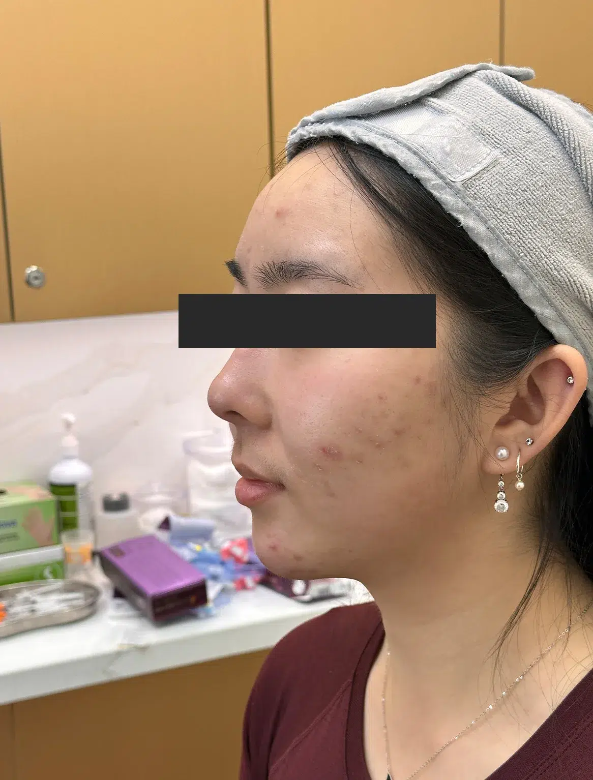 Jawline Contouring / Masseter Reduction — After · Case 28 · Luowei Medical Aesthetics Clinic