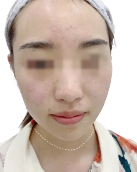 Luowei Skeletal Facial Contouring — Before Treatment · Case 01 · Luowei Medical Aesthetics Clinic