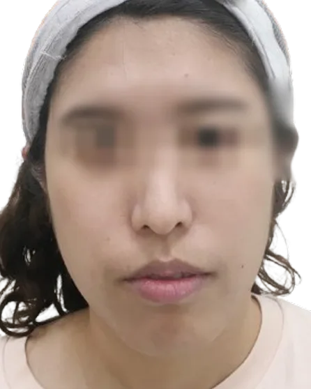 Recessed Chin — Before · Case 6 · Luowei Medical Aesthetics Clinic