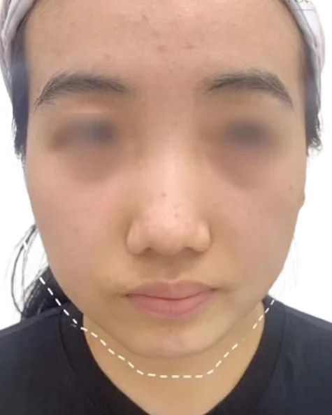Chin Retrusion — Before · Case 8 · Luowei Medical Aesthetics Clinic