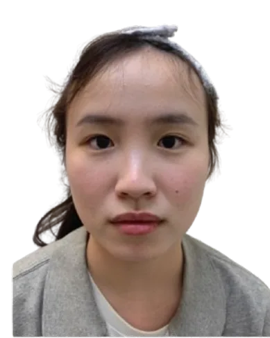 Chin recession — Before Treatment · Case 10 · Luowei Medical Aesthetics Clinic