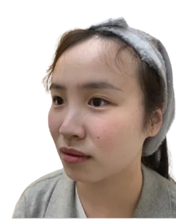 Luowei Skeletal Facial Contouring — Before Treatment · Case 06 · Luowei Medical Aesthetics Clinic