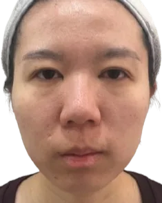 Chin Retrusion — Before · Case 13 · Luowei Medical Aesthetics Clinic