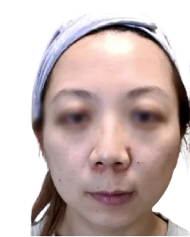 Chin recession — Before Treatment · Case 15 · Luowei Medical Aesthetics Clinic
