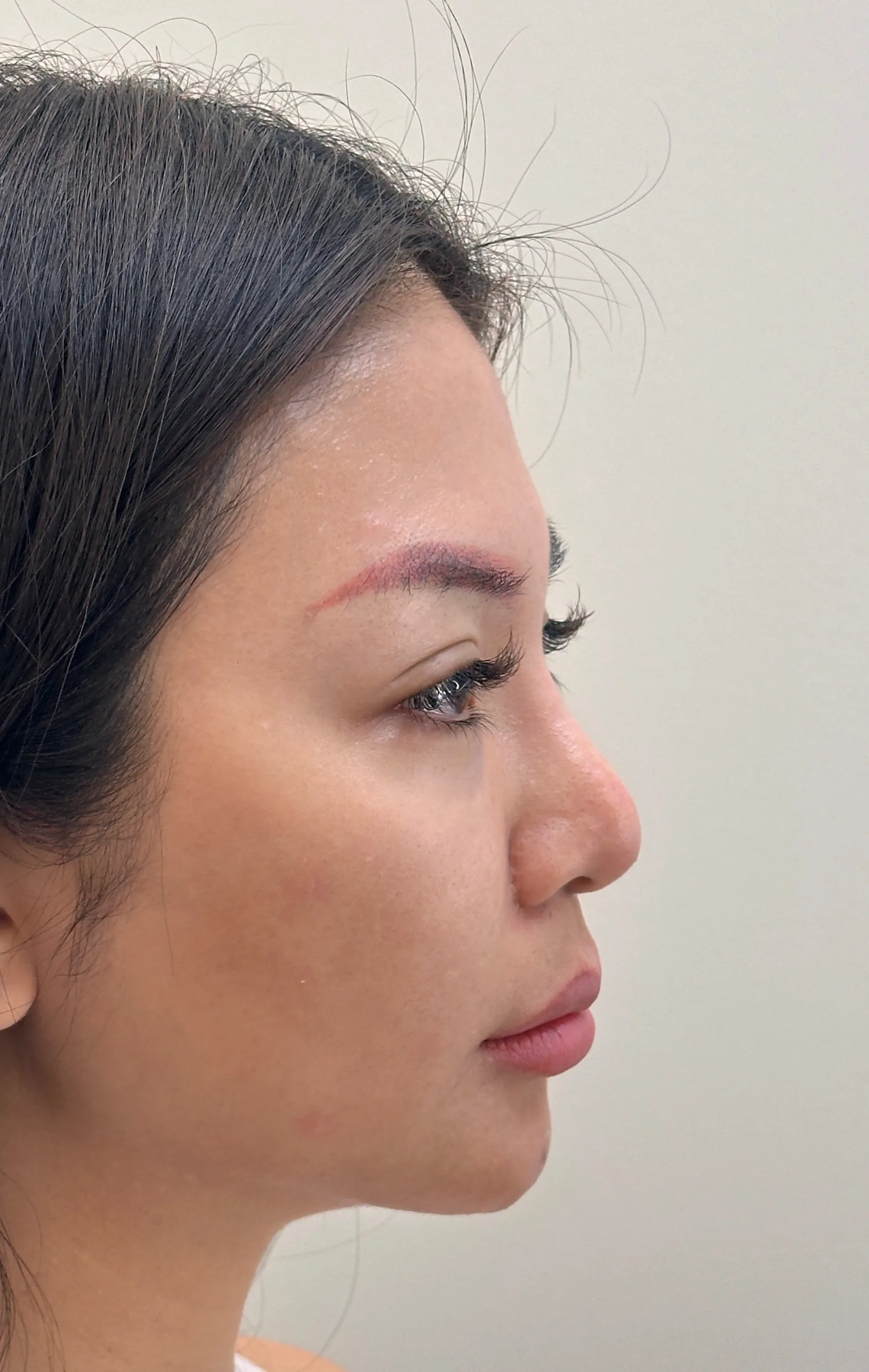 Chin Retrusion — Before · Case 19 · Luowei Medical Aesthetics Clinic