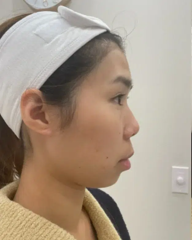 Chin Recession Before Treatment · Case 2 · Luowei Medical Aesthetics Clinic