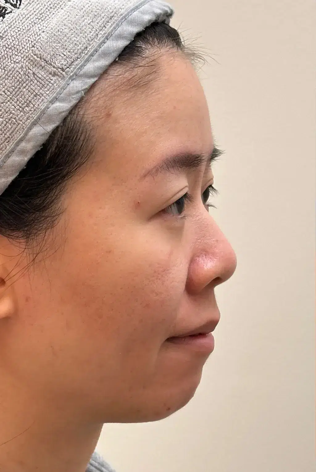 Recessed chin · Before · Case 40 · Luowei Medical Aesthetics Clinic