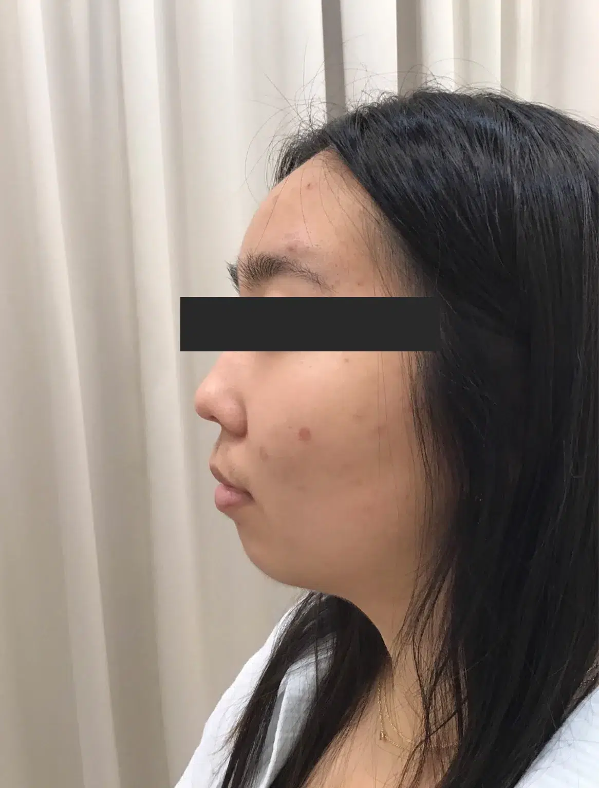 Jawline Contouring / Masseter Reduction — Before · Case 28 · Luowei Medical Aesthetics Clinic
