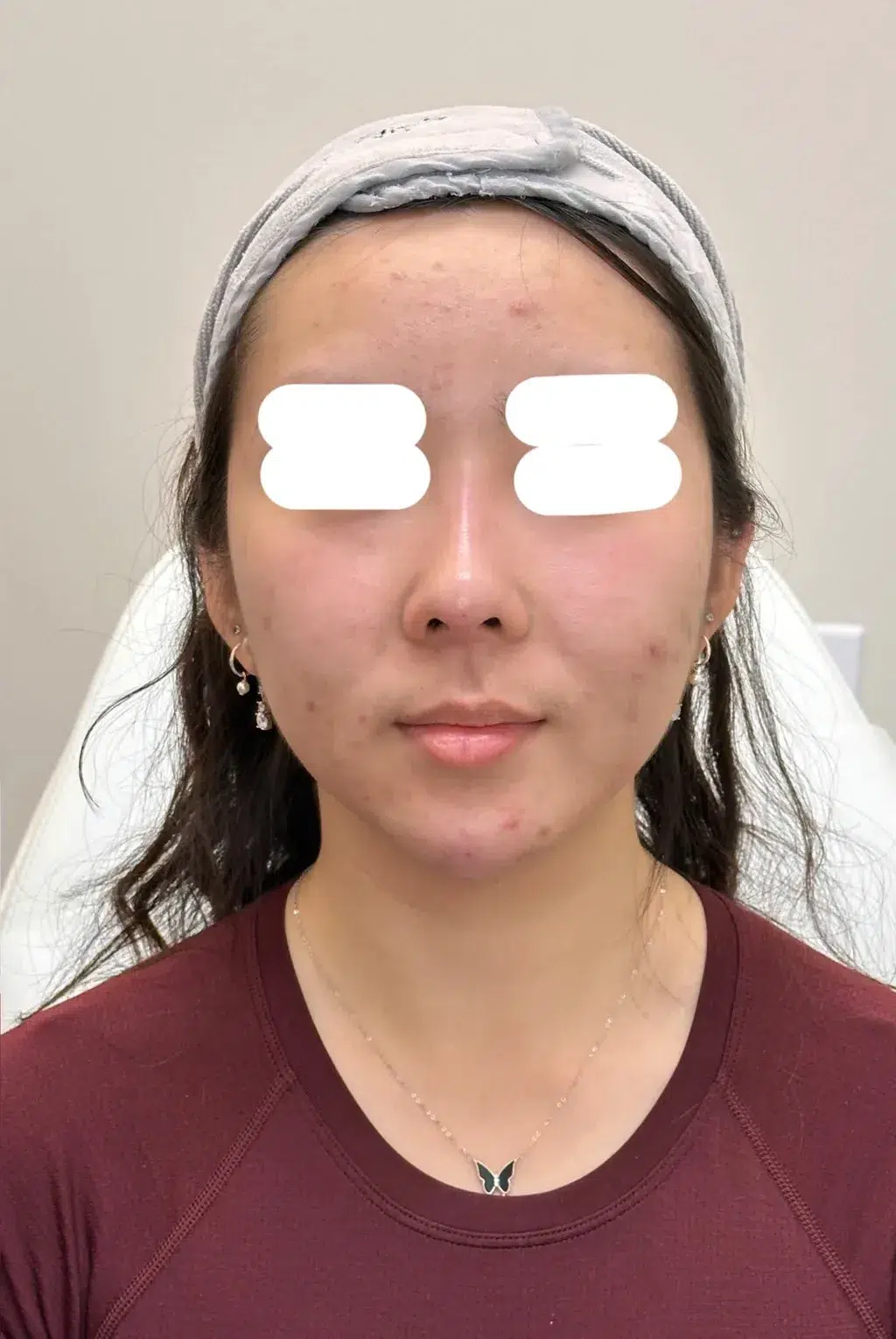 Nose Reshaping / Nasal Augmentation — After Treatment · Case 1 · Luowei Medical Aesthetics Clinic