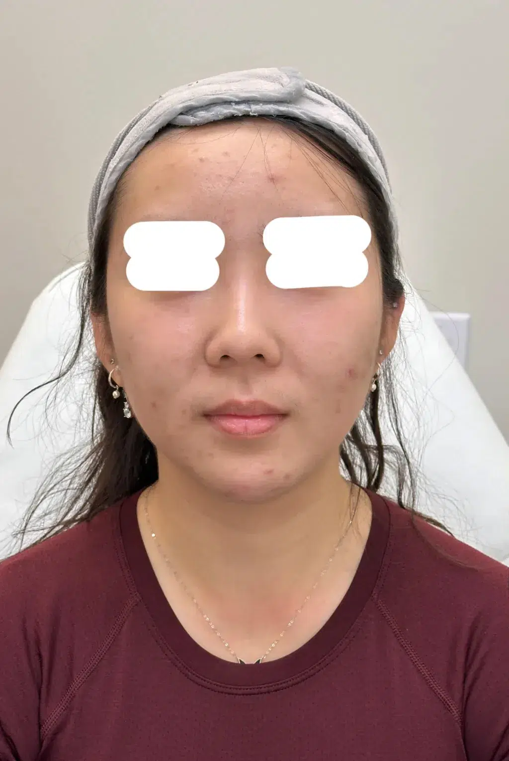 Nose Reshaping/Augmentation — Before Treatment · Case 1 · Luowei Medical Aesthetics Clinic