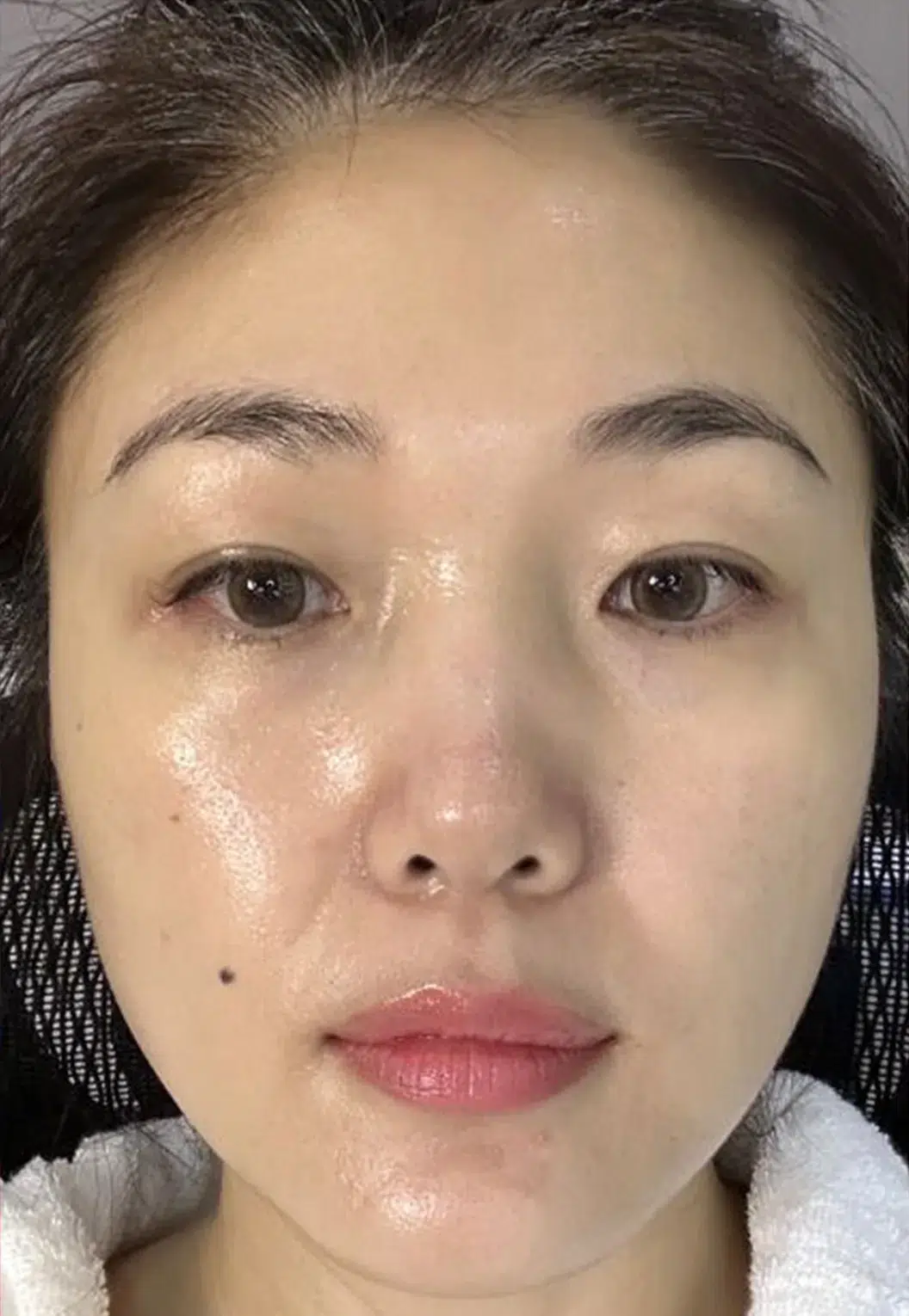 BTL ExilisSkin Laxity Improvement Before & After · Collagen Tightening · Luowei Medical Aesthetics Clinic Nanjing · Case 01