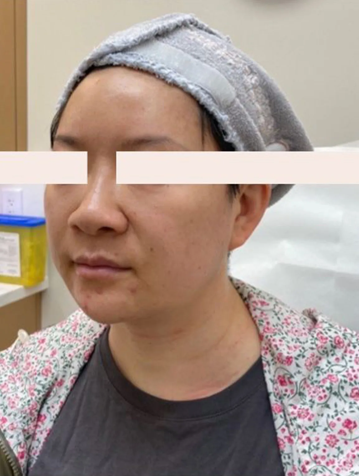 Facial Sagging — After Treatment · Case 02 · Luowei Medical Aesthetics Clinic