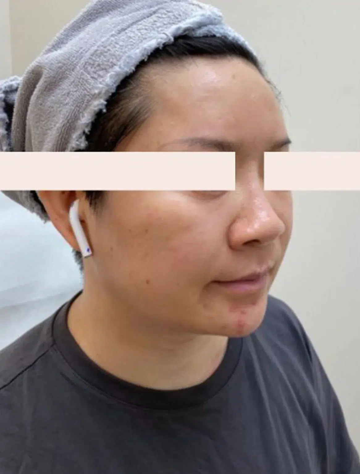 Skin Sagging — After Treatment · Case 5 · Luowei Medical Aesthetics Clinic
