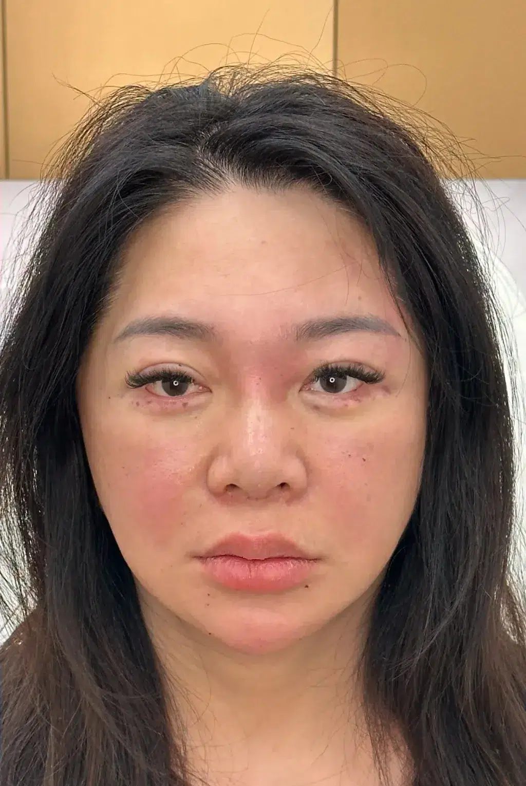 Tired, Aged & Fatigued Appearance — After Treatment · Case 08 · Luowei Medical Aesthetics Clinic