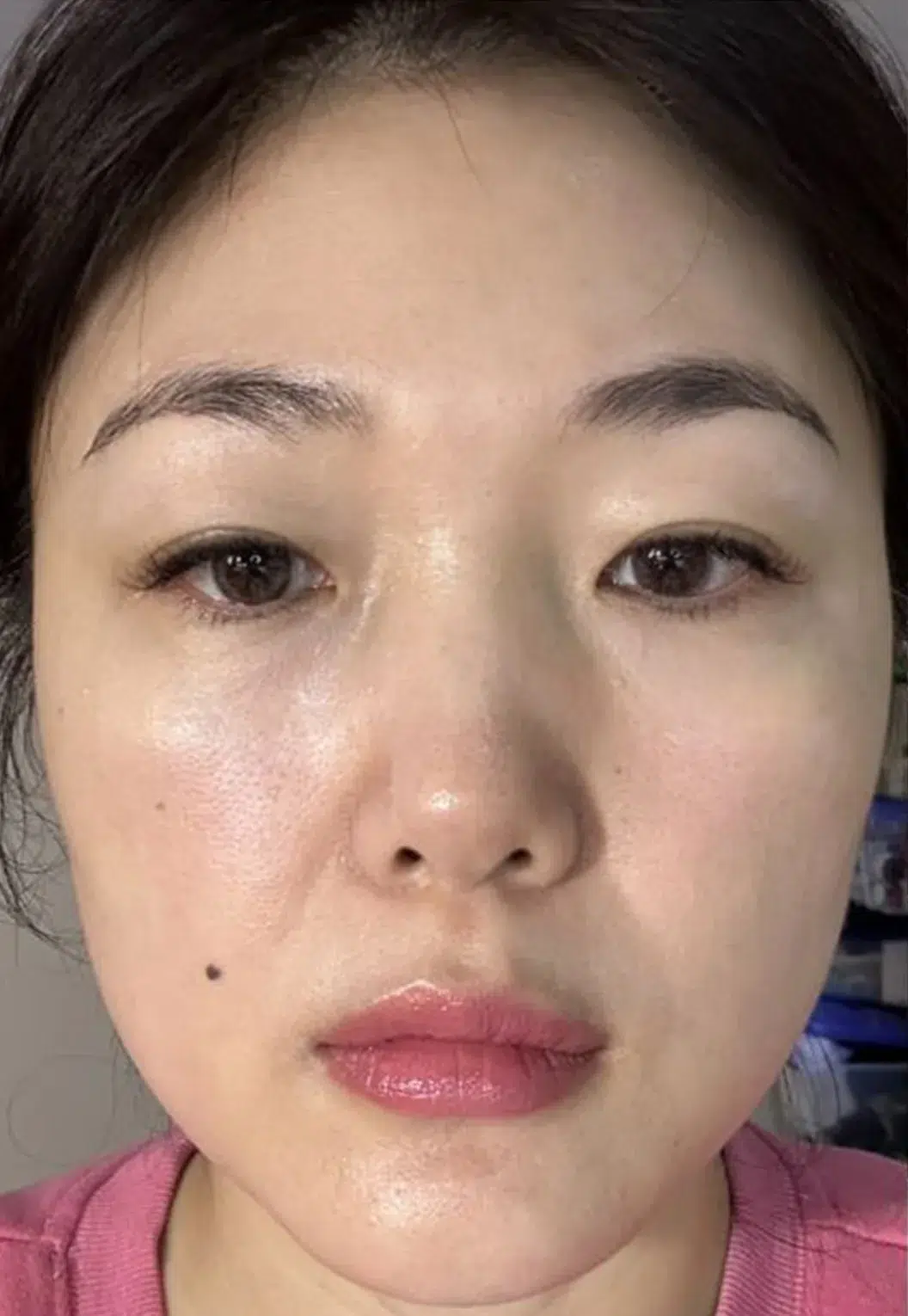 BTL ExilisSkin Laxity Improvement · Before & After · Collagen Tightening · Luowei Medical Aesthetics Clinic Nanjing · Case 01
