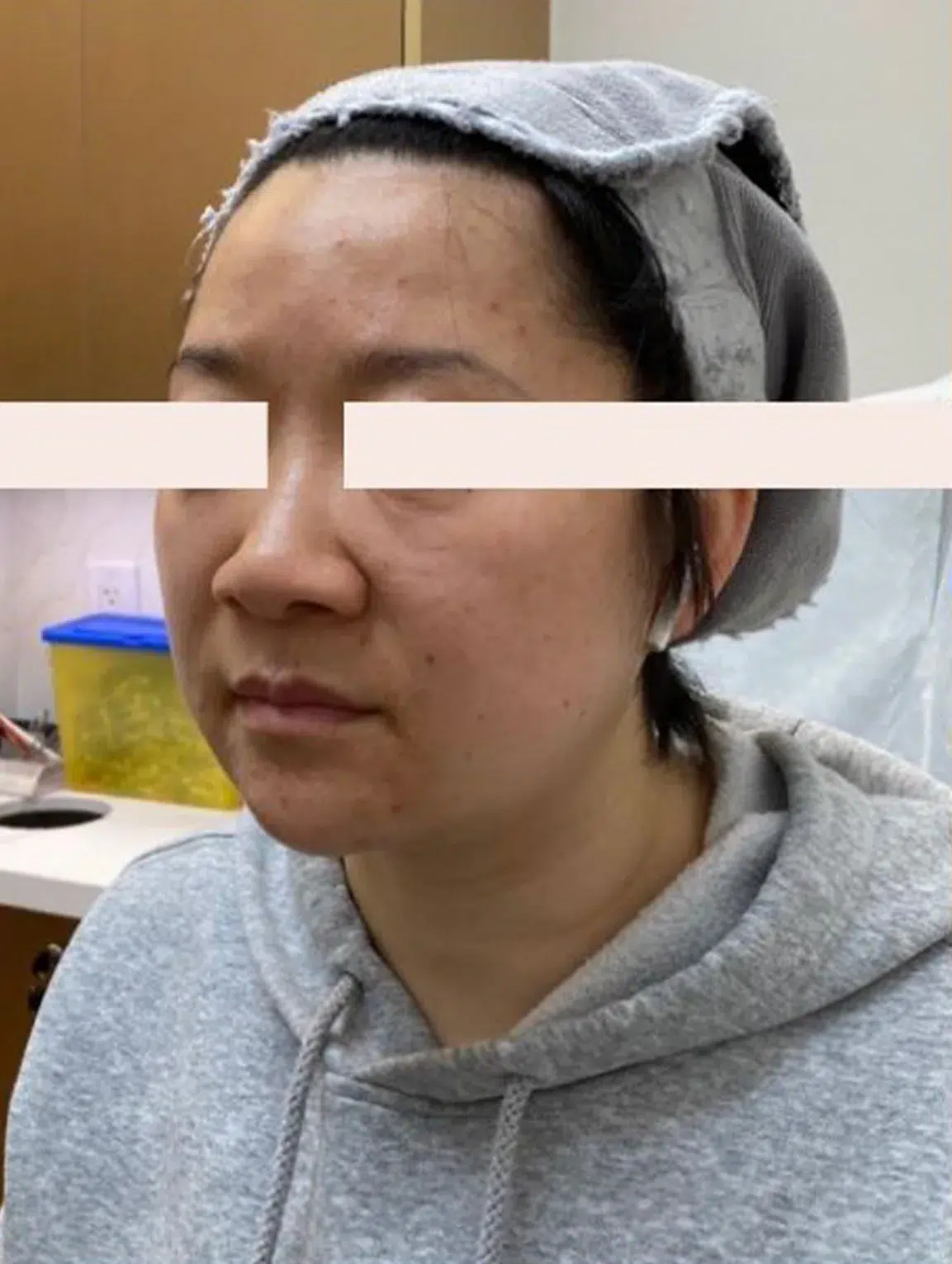 Facial Sagging — Before Treatment · Case 02 · Luowei Medical Aesthetics Clinic