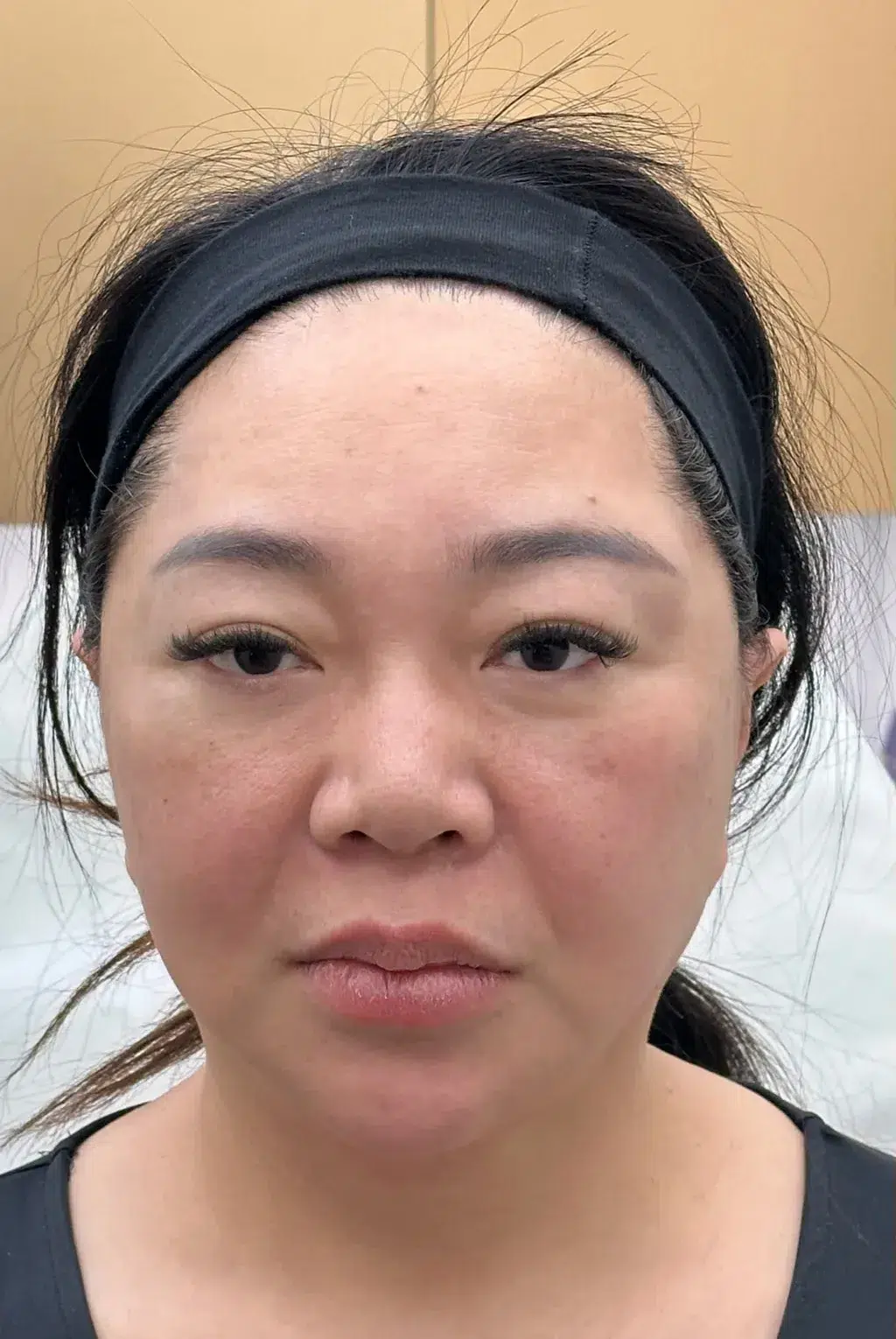 Tired, Aged & Fatigued Appearance — Before Treatment · Case 08 · Luowei Medical Aesthetics Clinic