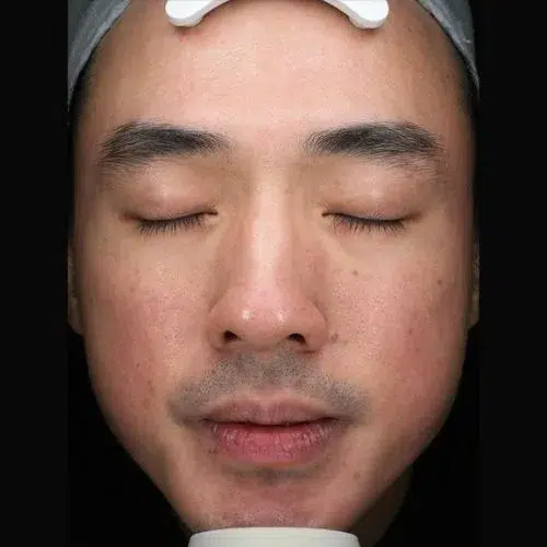 Deep Cleansing & Hydration Facial — Improved Sensitivity & Dullness · Gentle Hydration · Luowei Medical Aesthetics Clinic Nanjing · Case 01
