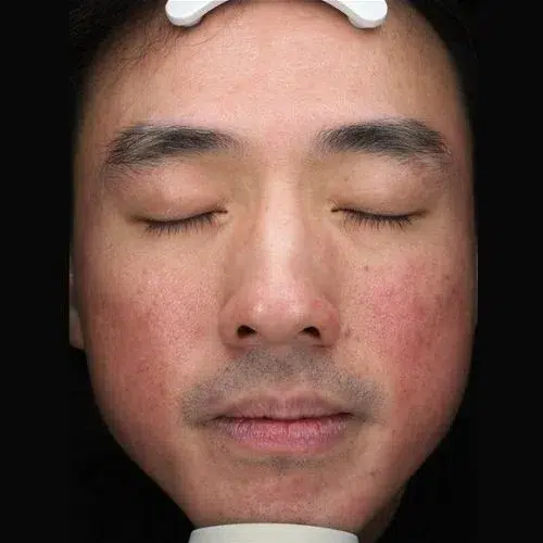 Deep Cleansing & Hydration — Sensitive & Dull Skin, Before Treatment · Gentle Hydration · Luowei Medical Aesthetics Clinic Nanjing · Case 01