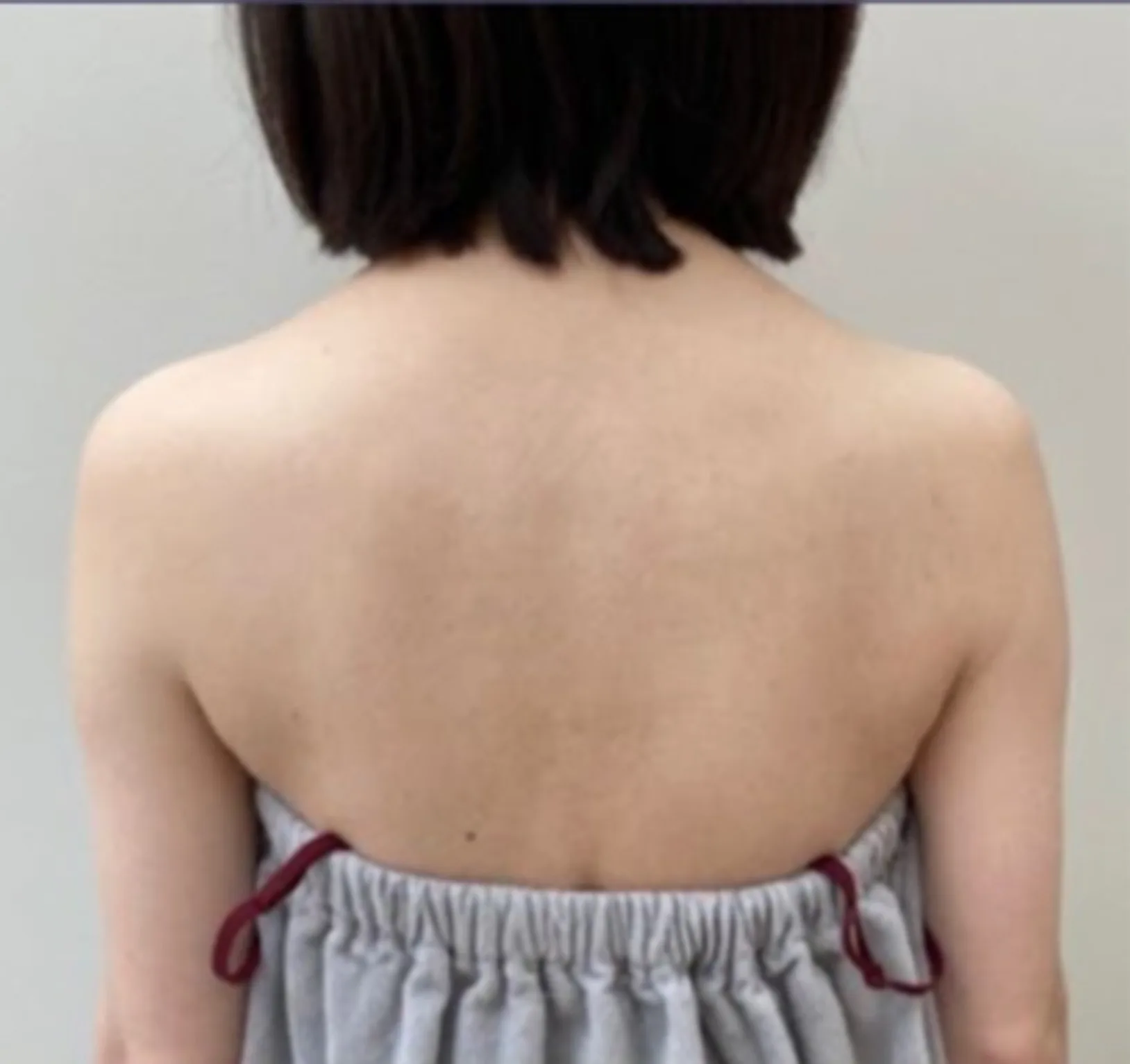 After Shoulder-Slimming Treatment · Case 1 · Luowei Medical Aesthetics Clinic