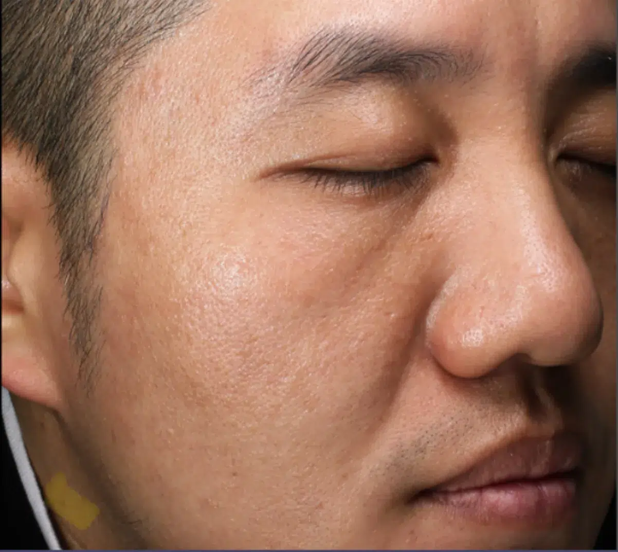 Hyperpigmentation After · Case 01 · Luowei Medical Aesthetics Clinic