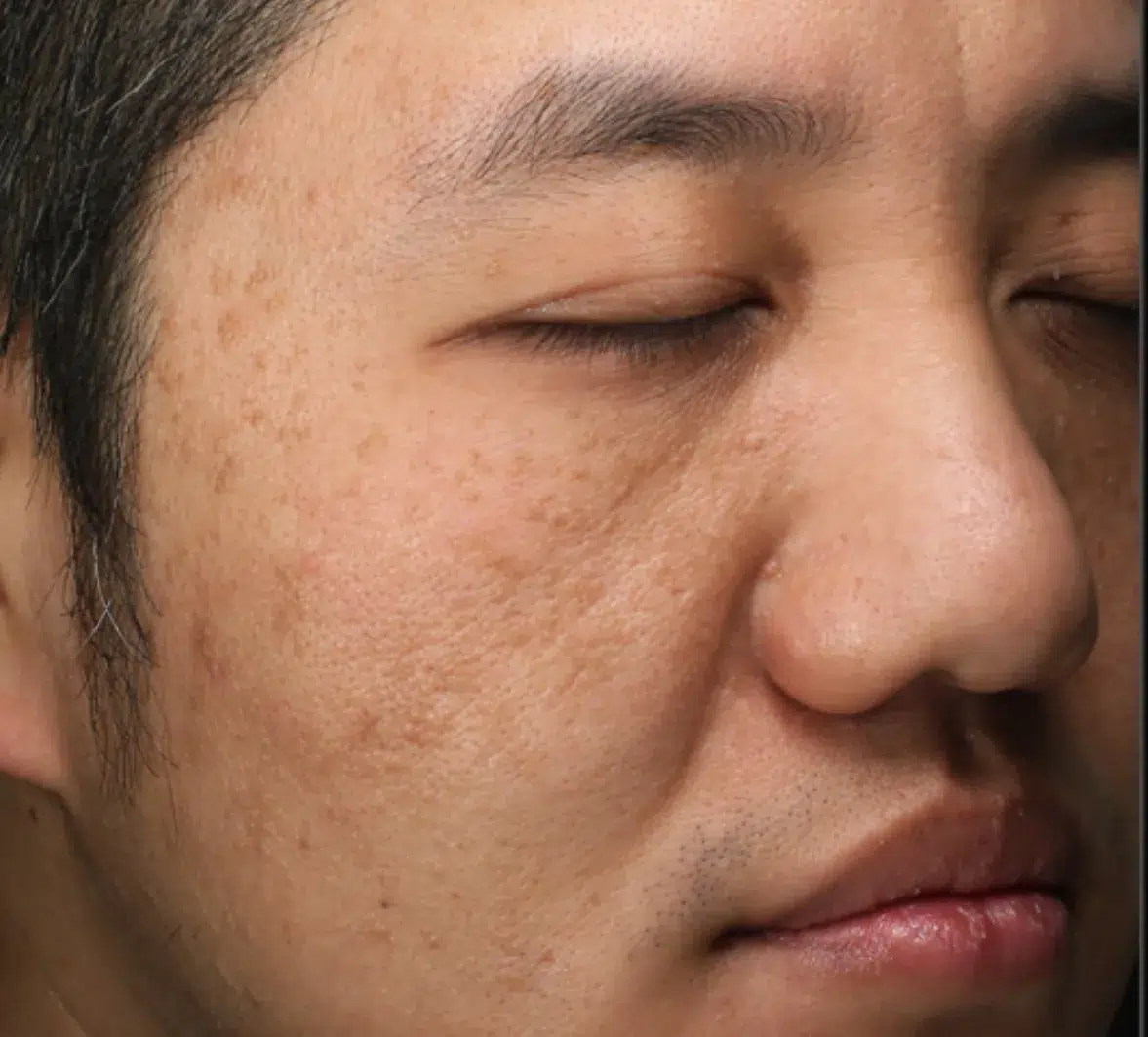 Pigmentation Before · Case 01 · Luowei Medical Aesthetics Clinic