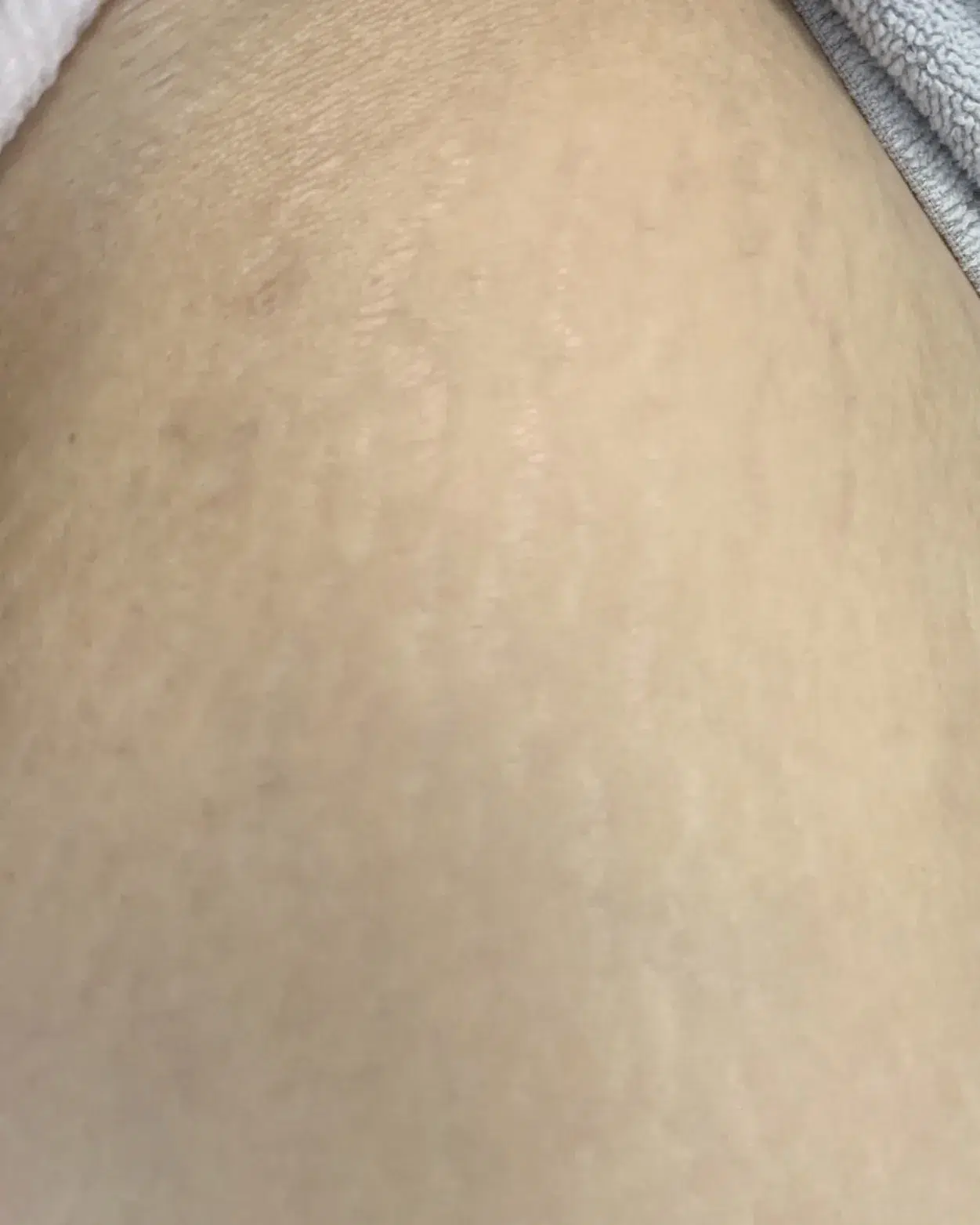 Cellulite Treatment · After · Case 01 · Luowei Medical Aesthetics Clinic