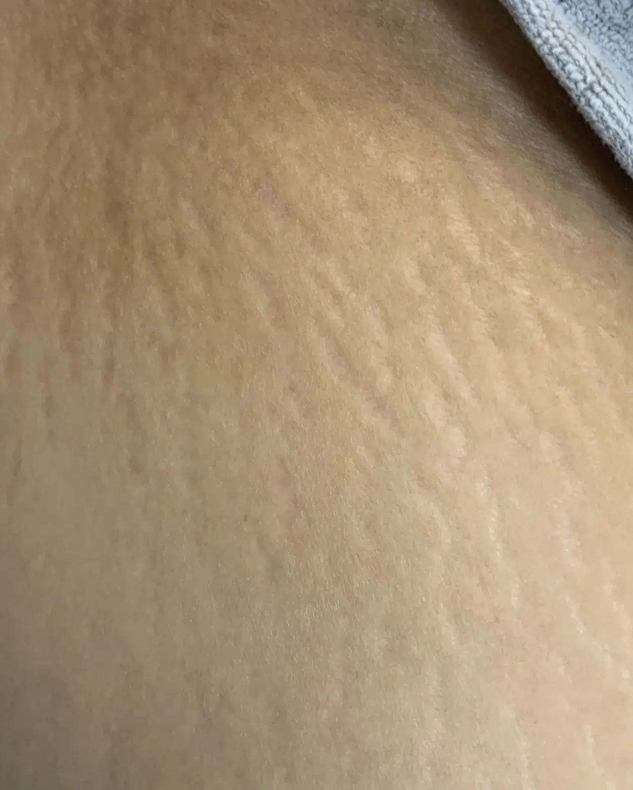 Cellulite Treatment — Before · Case 01 · Luowei Medical Aesthetics Clinic