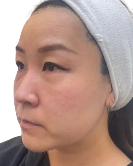 Under-Eye Dark Circles — After Treatment · Case 01 · Luowei Medical Aesthetics Clinic