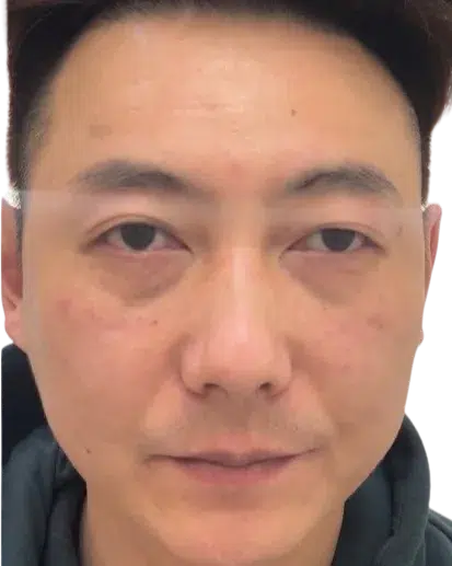 Tear Trough After Treatment · Case 2 · Luowei Medical Aesthetics Clinic