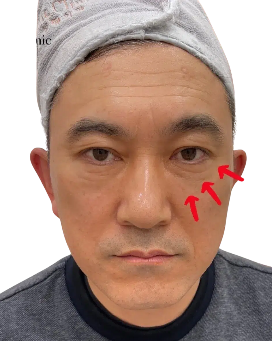Tear Trough After Treatment · Case 3 · Luowei Medical Aesthetics Clinic